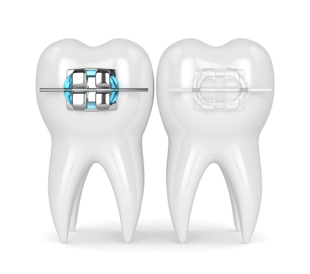 Frenos Transparentes En Las Vegas 1 Concept Image Metal Braces Vs Clear Ceramic Braces 1054W