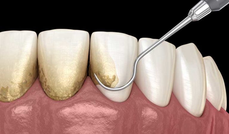 6 Maneras En Que Las Visitas Al Dentista Ayudan Con El Mal Aliento (Más 4 Consejos Dentales) 2 Dental Tools Removing Tartar 768X451 1