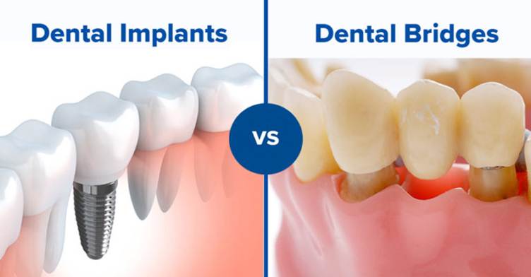 Puente Vs Implante Dental: Cómo Encontrar La Mejor Opción Para Ti 1 Puente Vs Implante Dental