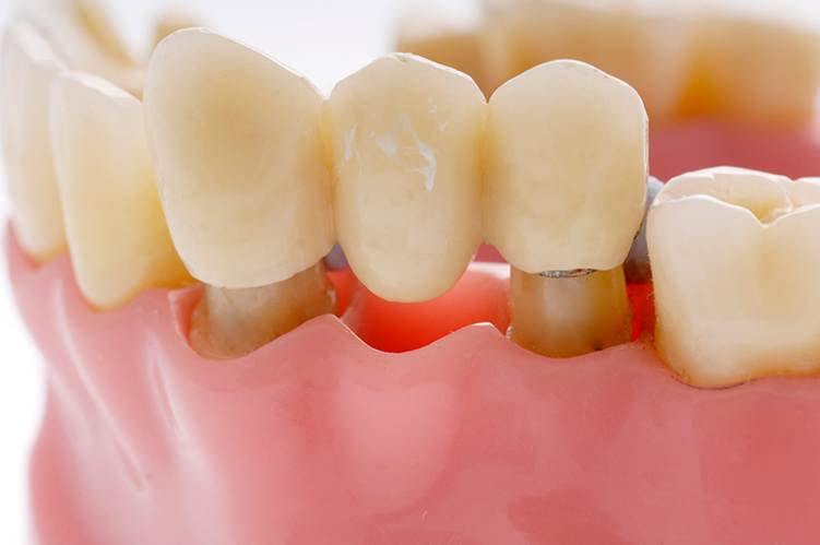 Puente Vs Implante Dental: Cómo Encontrar La Mejor Opción Para Ti 3 Qué Es Un Puente Dental