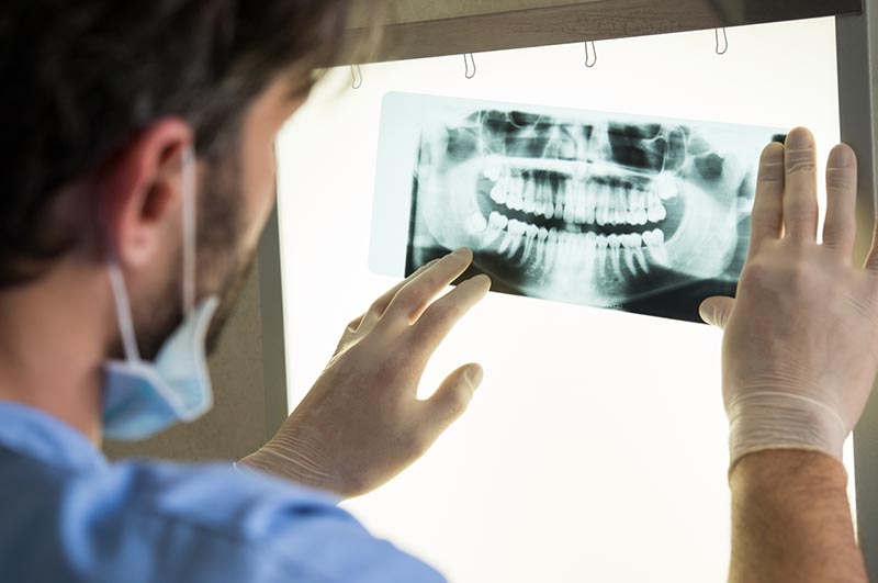 5 Qué Hacer Y Qué No Hacer Después De La Extracción De Las Muelas Del Juicio 3 Wisdom Teeth Extraction X Ray