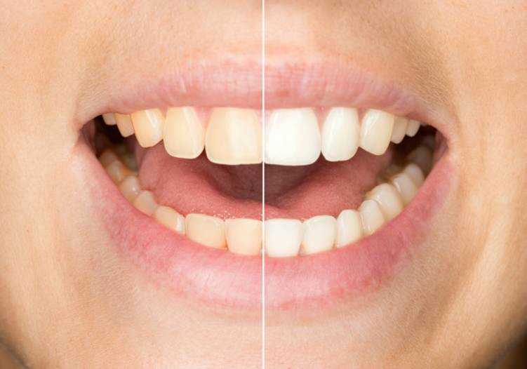 Blanqueamiento Dental En Las Vegas 1 Image3