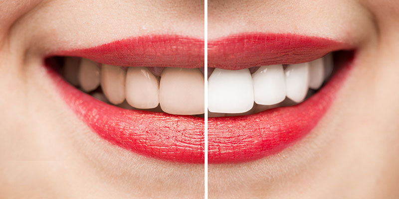 Servicio De Blanqueamiento Dental En Reno, Nv 1 Teeth Whitening Before And After