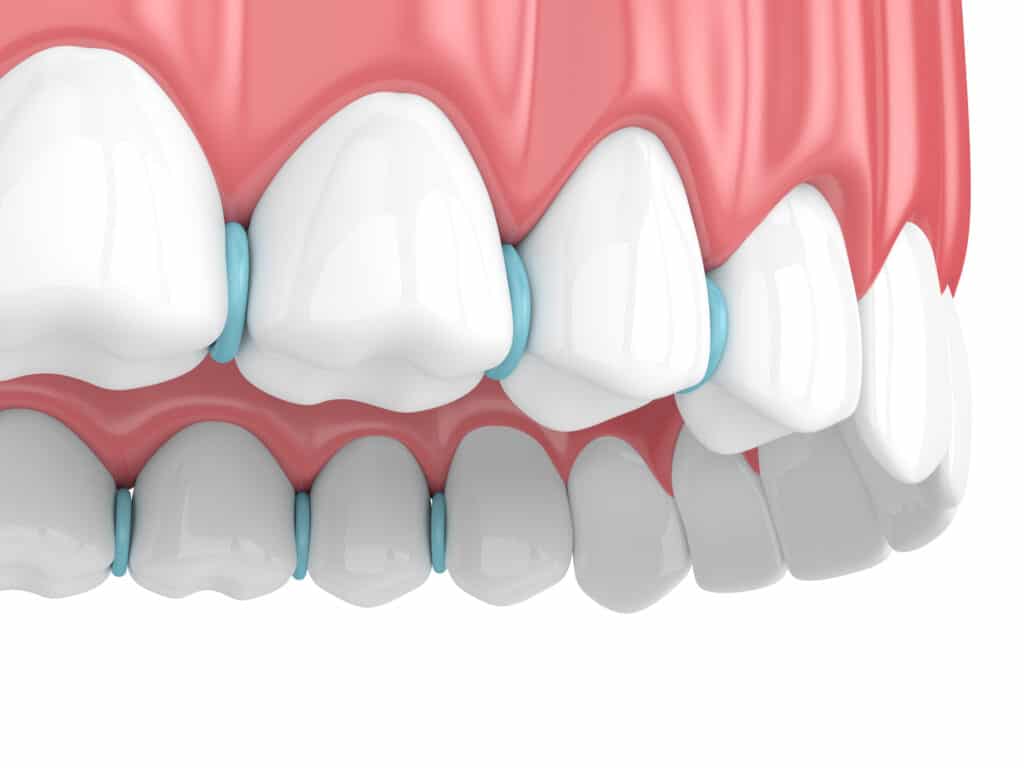 Atención De Emergencias De Ortodoncia En Las Vegas 5 Teeth Seperators 1024X768 1