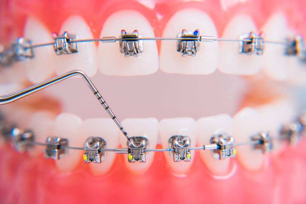 Atención De Emergencias De Ortodoncia En Las Vegas 4 Teeth With Braces 1024X684 1