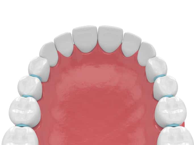Separador Para Brackets Perdido 1 Imagen 3D De Separadores Dentales